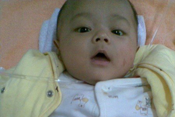  胆道闭锁 图片大全_ 胆道闭锁 图片下载